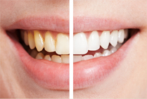 Clareamento dental